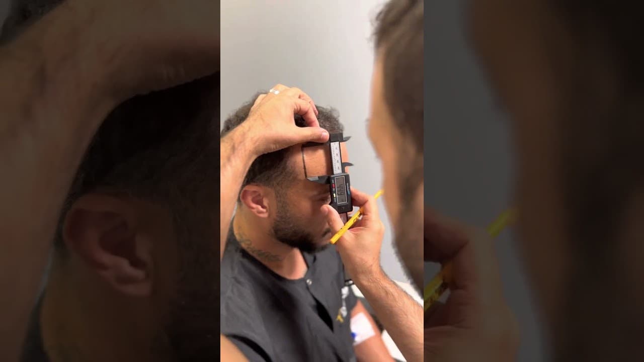 Hairline Planning by Doctor