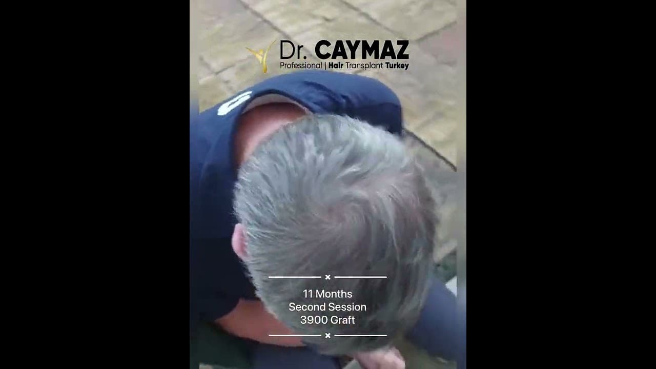 Second Session Hair Restoration