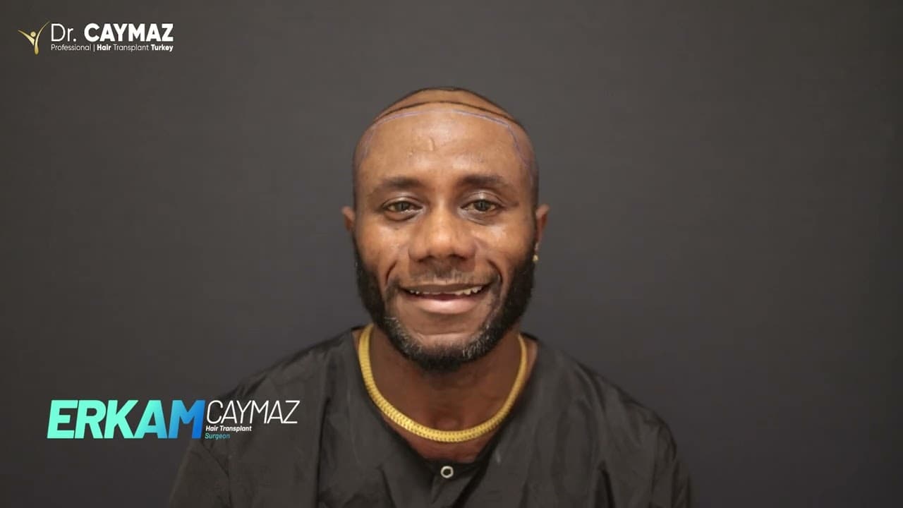 Christopher Sieh | Sapphire FUE | 3200 Graft | Australia Hair Transplant