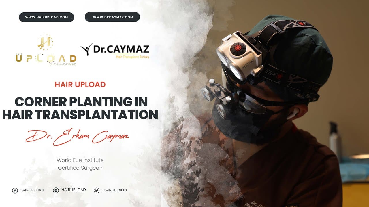 Corner Planting in Hair Transplantation