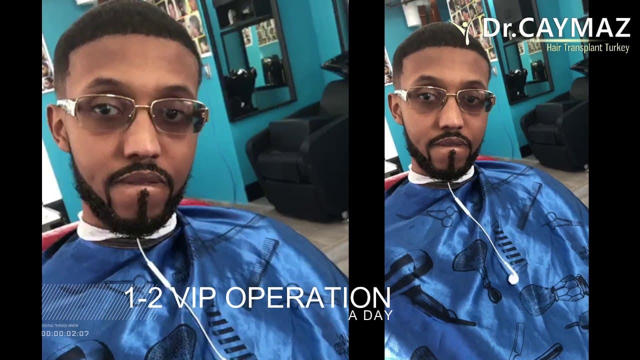 Afroamerican 5,5 Months Result - 3600 Graft