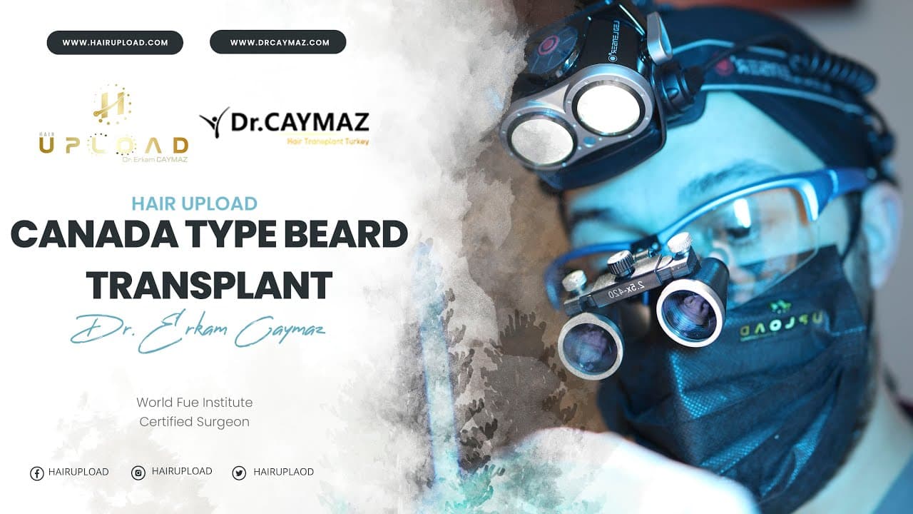 Canada Type Beard Transplant
