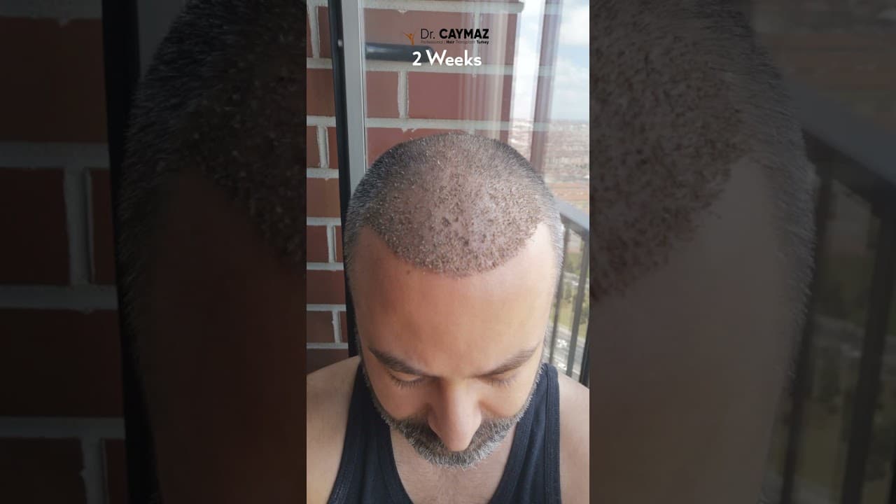 Hair Growth Progress
