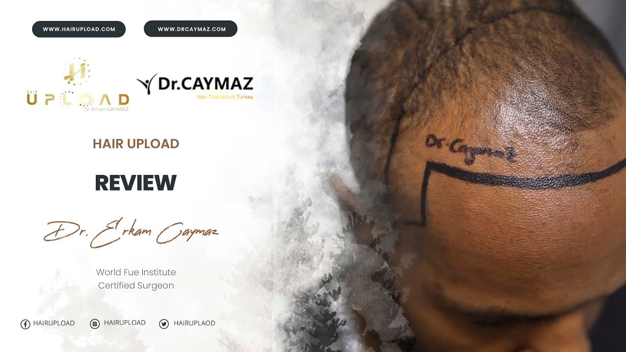 KHADIJAH ATTALLAH - 2500 Graft | Hair Transplant Review | USA