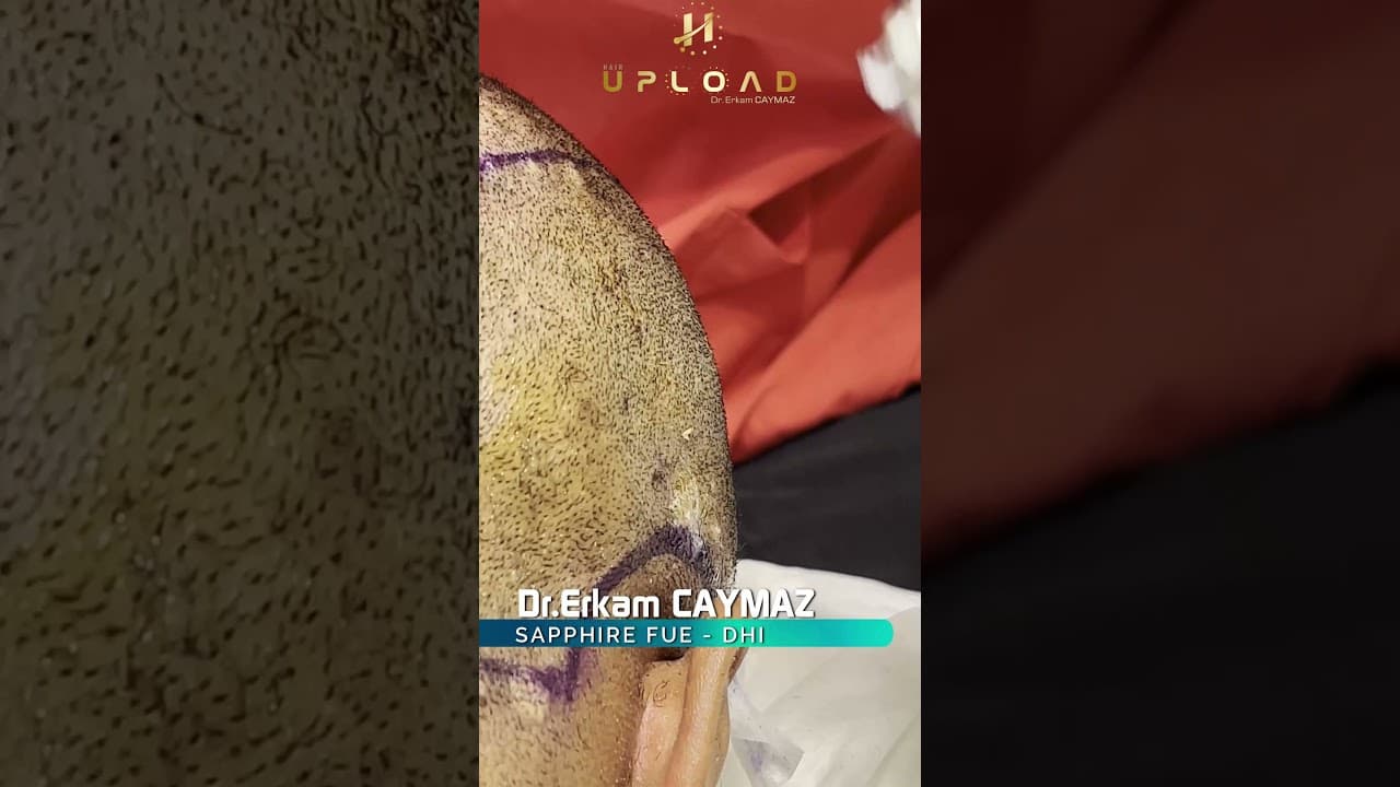 Needleless Anesthesia with Dermojet in Hair Transplantation