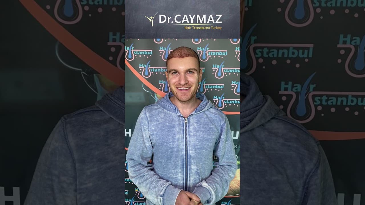 Mr SOHRAB from CANADA - 4650 Graft | Hair Transplant Review