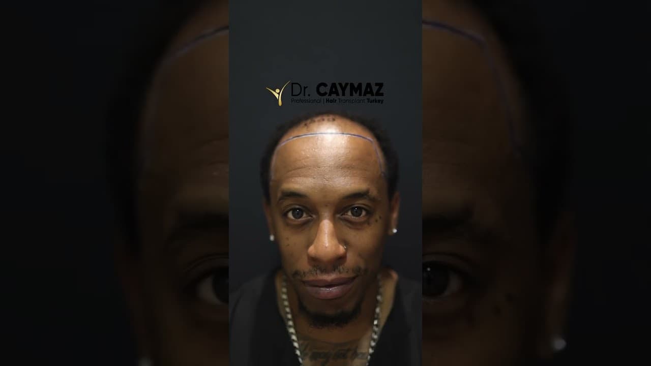 Mr Lee 4500 Graft - 6,5 Months