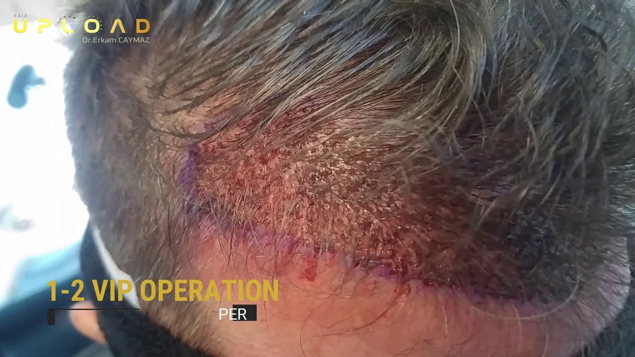 Unshaven Hair Transplantation