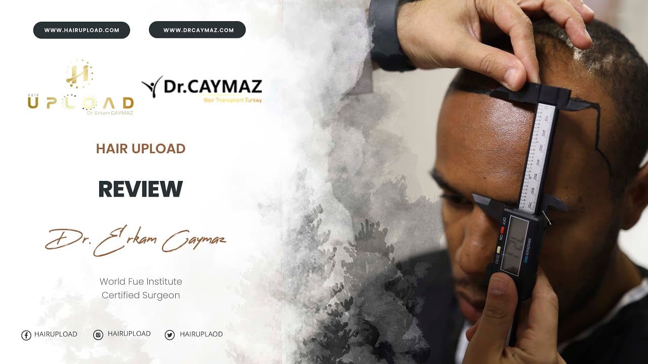 Cameron George Roberts - 4100 Graft | Hair Transplant Review | USA