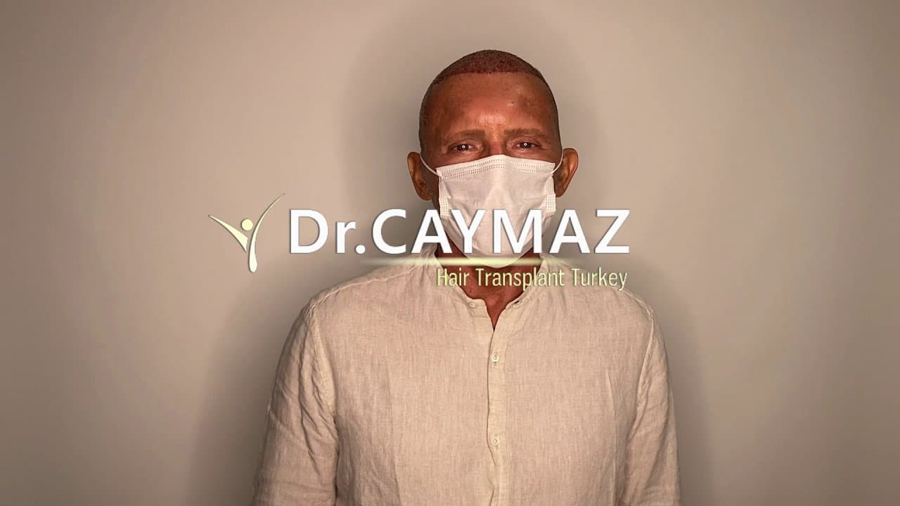 Mr Jorge Miami,Usa - 5100 Graft | Hair Transplant 