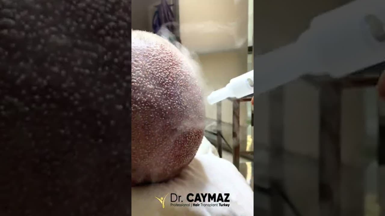 Hair Transplantation in the World