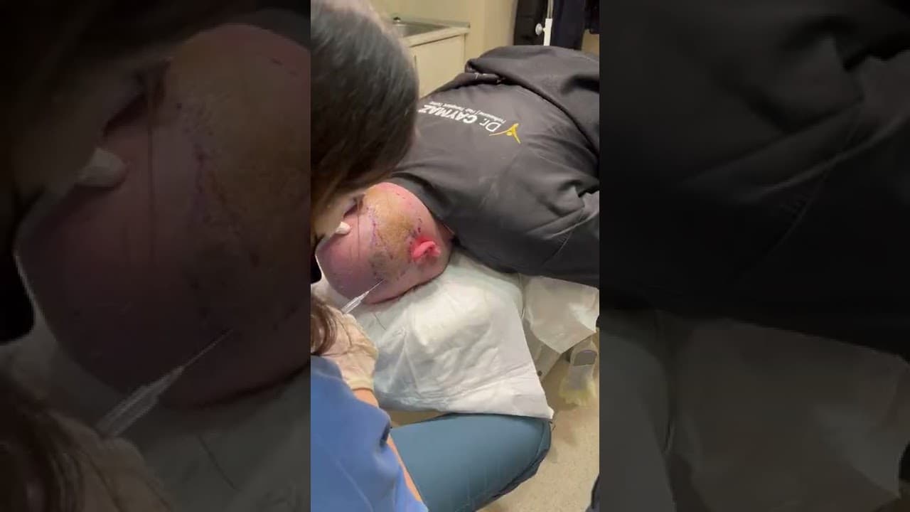 Private and Vip Hair Transplant Operations