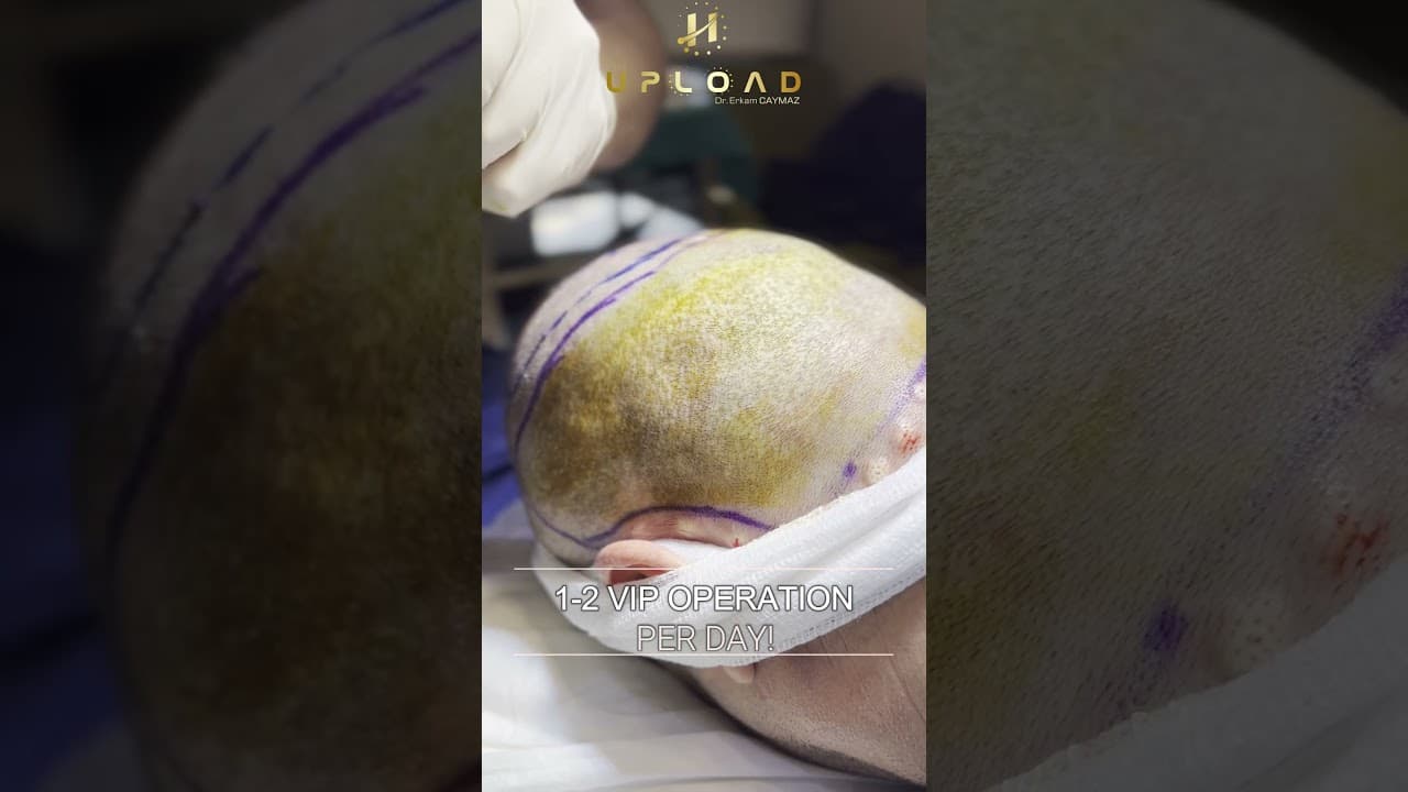 Needleless Anesthesia