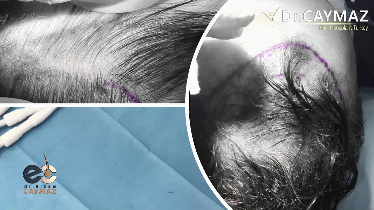 DHI CHOI PEN - UNSHAVEN OPERATION