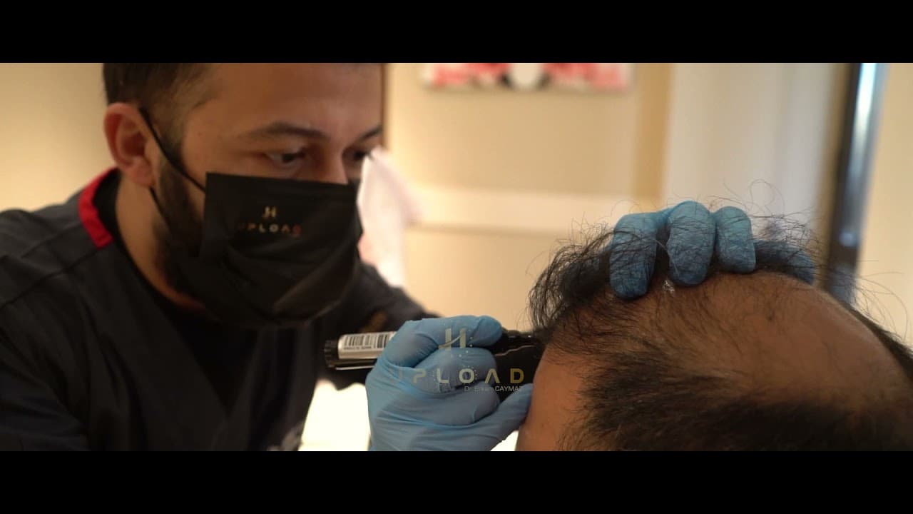 Hairline Designing by Dr  CAYMAZ