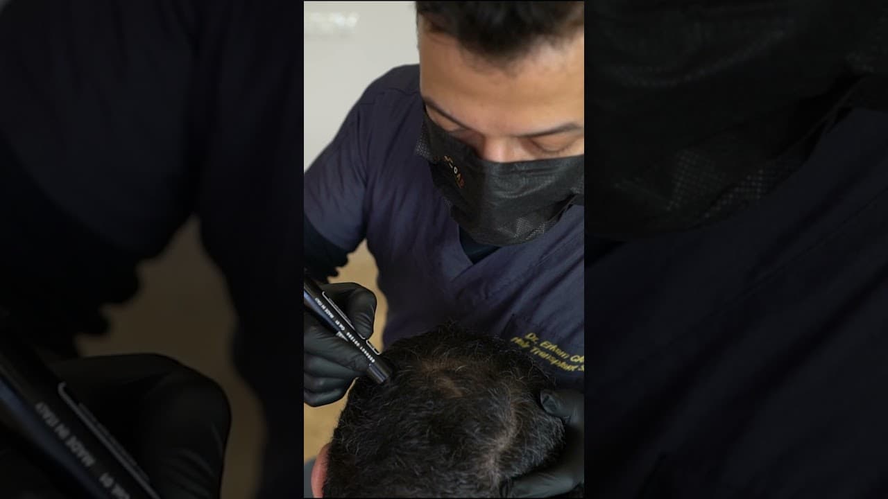 Hair Transplant Istanbul