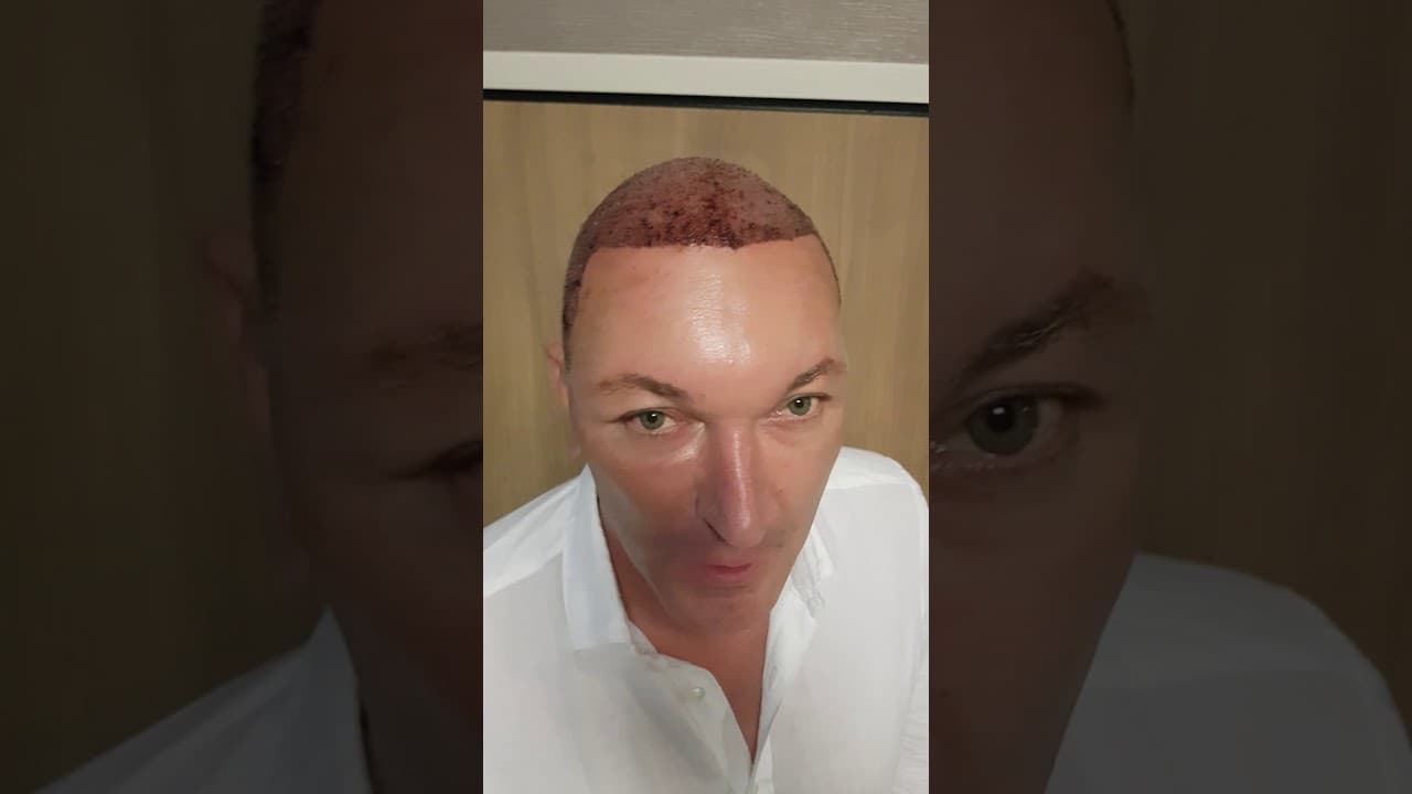Hair Transplant Review - Dr Erkam Caymaz