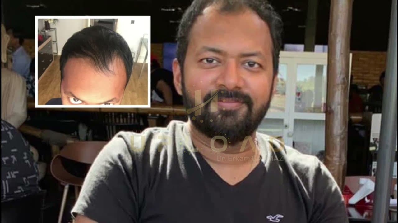 Mr.Jino Hair Transplant / 4500 graft / 8 Month Result