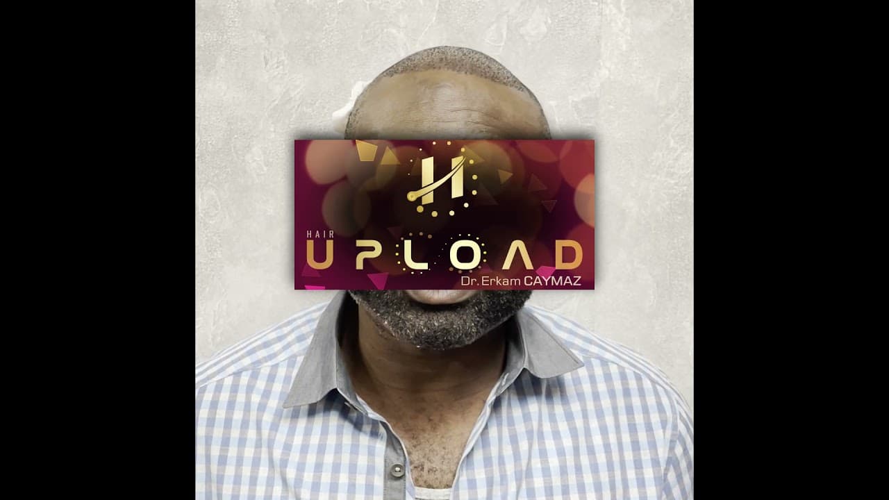 Mr Private - 2500 Graft  Sapphire Fue Technique | Dr Erkam CAYMAZ