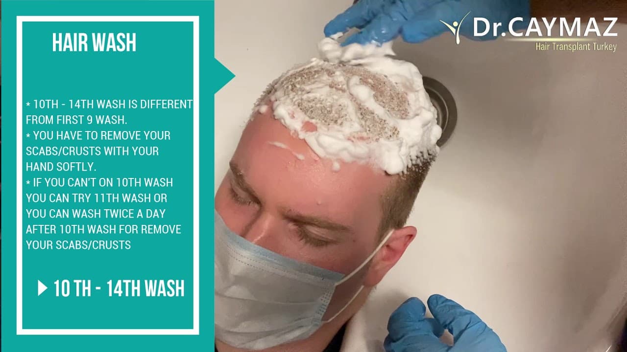 10th Hair Wash After Hair Transplantation