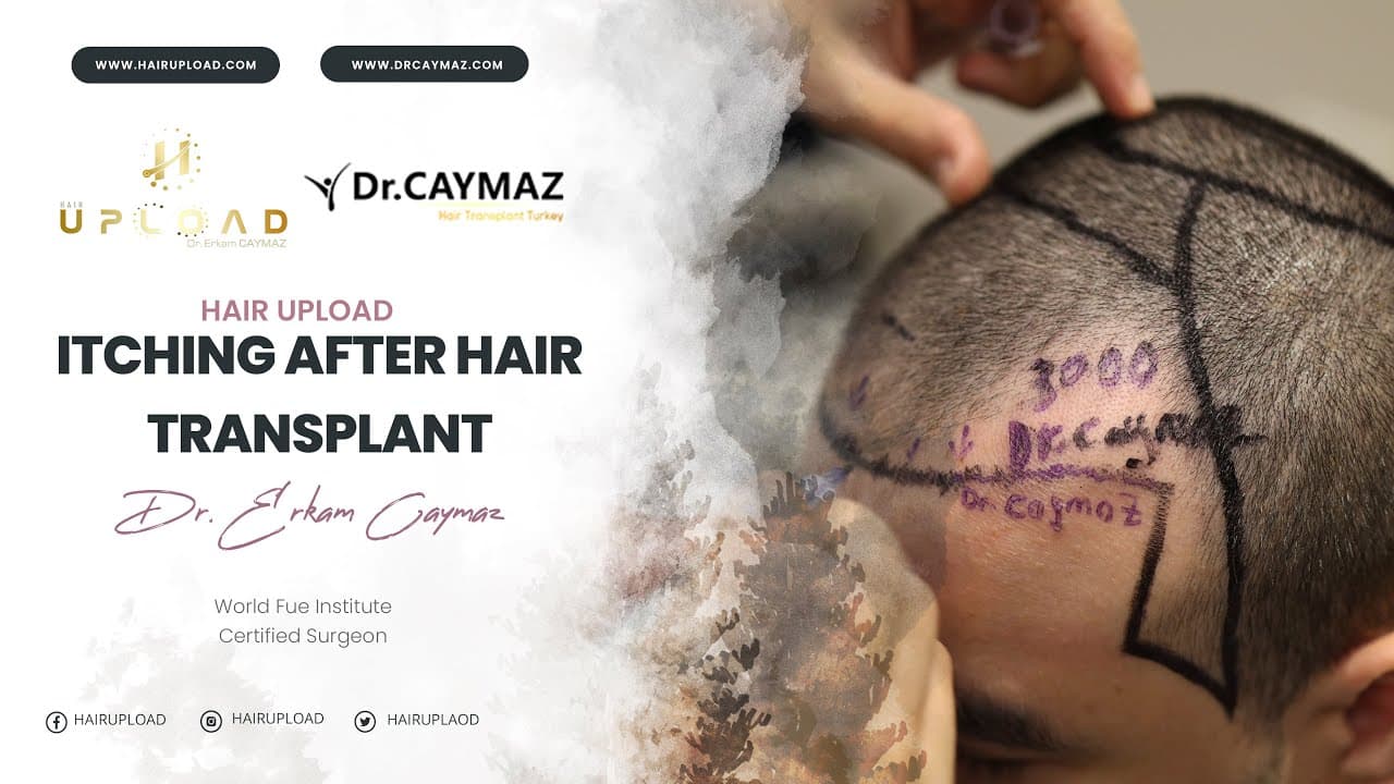 Itching after hair transplant