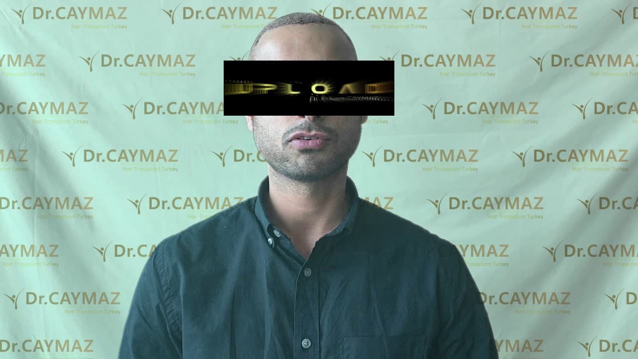 Mr.Private from Usa 4000 Graft Implanted | Hair Transplant in Istanbul Turkey | Dr.Caymaz