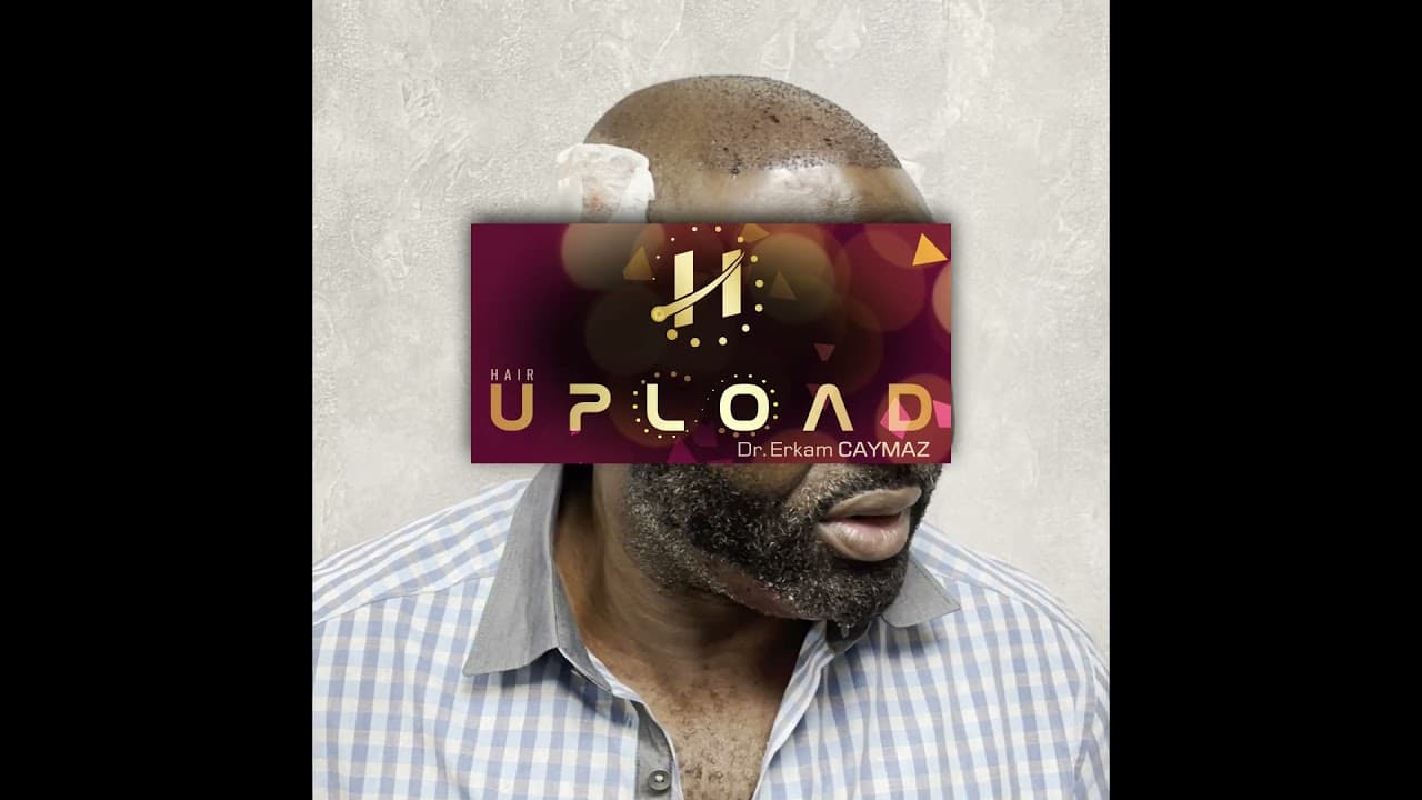 Mr Private   2500 Graft  Sapphire Fue Technique