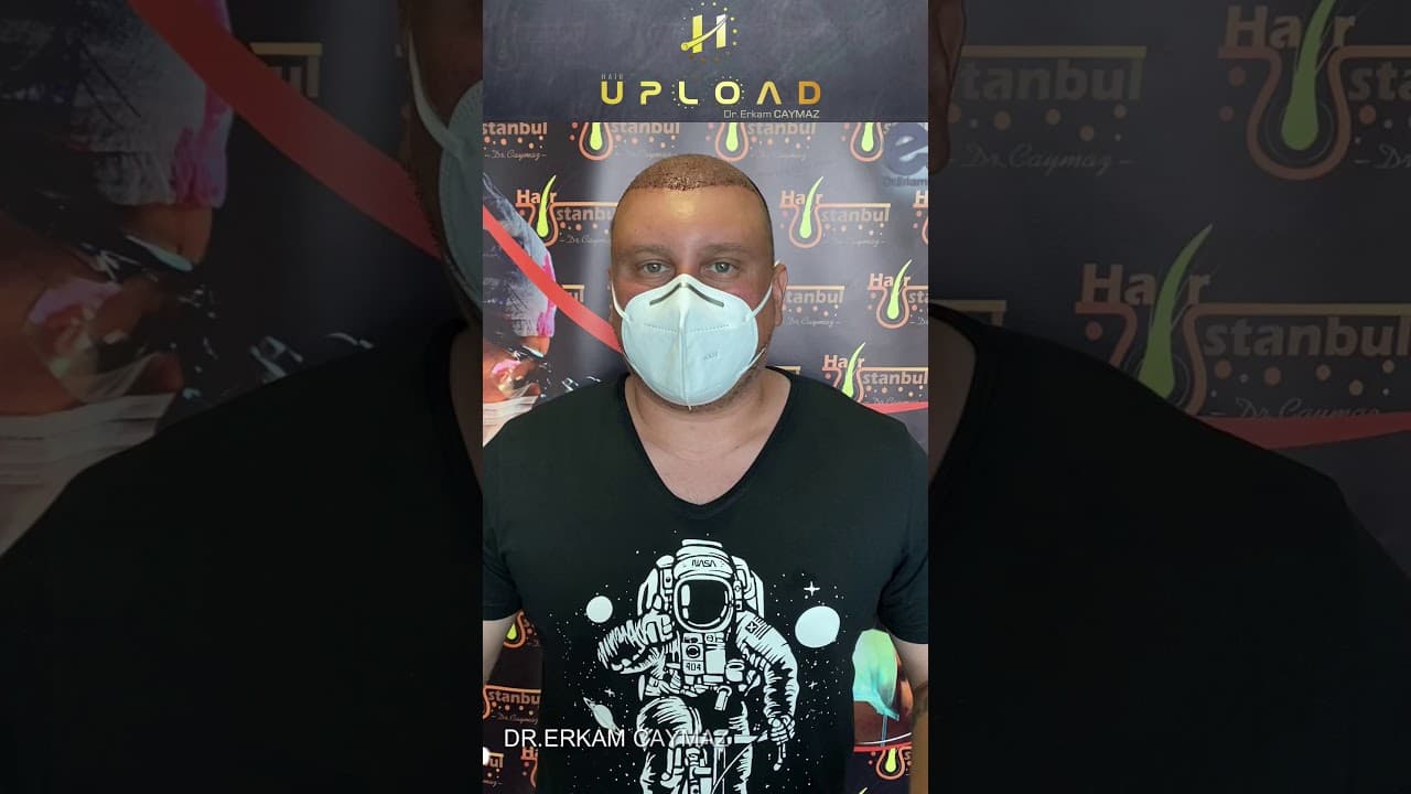 Mr MICHAEL from USA - 5300 Graft | Hair Transplant Review