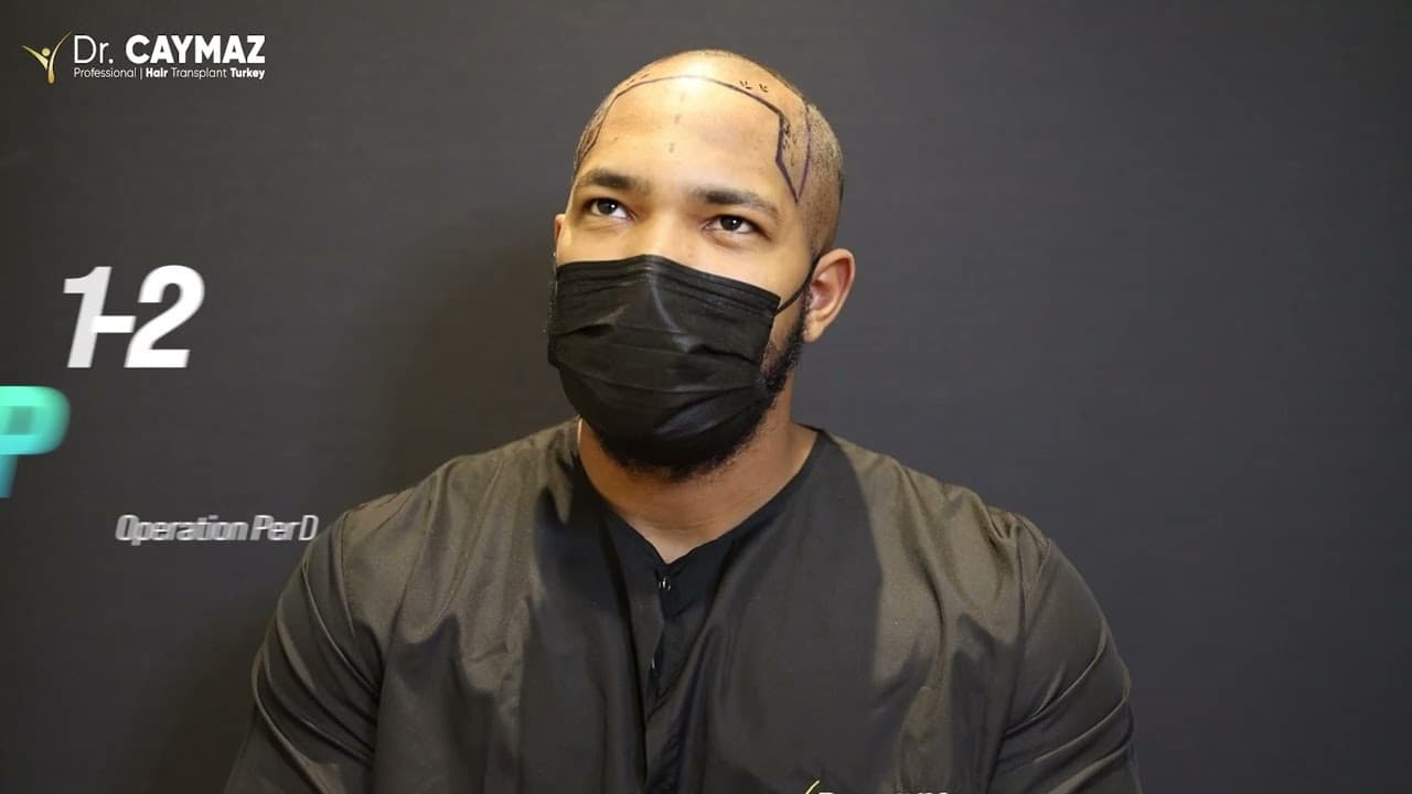 Henry Puello - USA - 4000 Graft - Afro American Hair Transplant Review - Sapphire Blade Incision