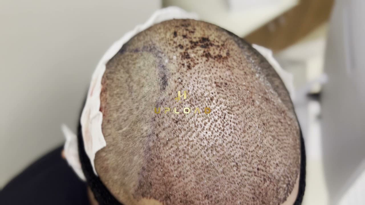 Mr ELVIR - 5250 Graft from USA | Dr Caymaz Hair Transplant Review in Turkey